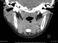Acute parotitis (Radiopaedia 54123-60294 Coronal C+ arterial phase 8).jpg