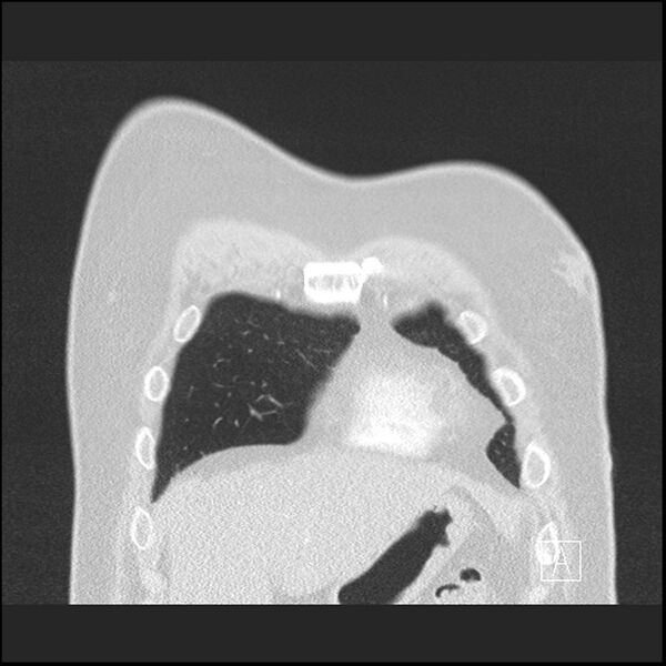 File:Acute pulmonary embolism with pulmonary infarct (Radiopaedia 73062-83768 Coronal lung window 9).jpg