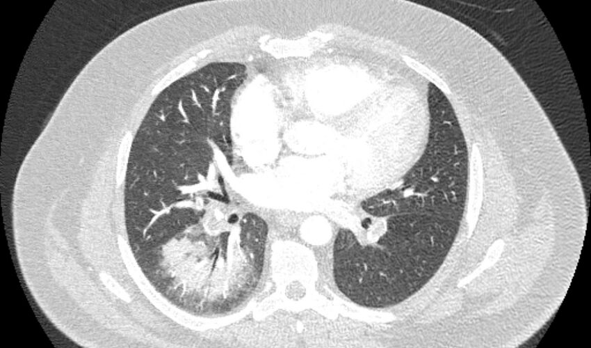 Acute pulmonary embolism with pulmonary infarcts (Radiopaedia 77688-89908 Axial lung window 67).jpg