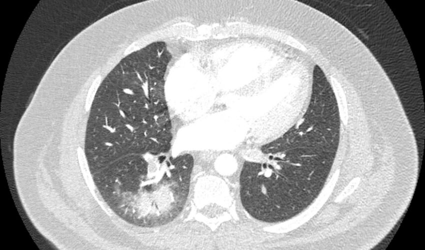 Acute pulmonary embolism with pulmonary infarcts (Radiopaedia 77688-89908 Axial lung window 73).jpg