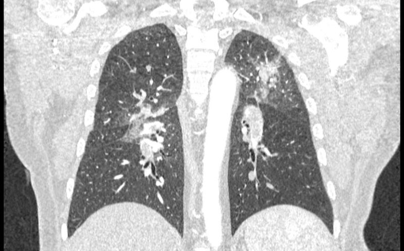 File:Acute pulmonary embolism with pulmonary infarcts (Radiopaedia 77688-89908 Coronal lung window 67).jpg