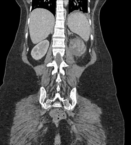 File:Acute pyelonephritis with renal vein thrombosis (Radiopaedia 58020-65053 Coronal renal parenchymal phase 96).jpg