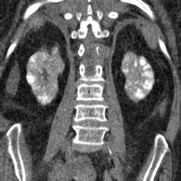 File:Acute tubular necrosis (Radiopaedia 28077-28334 Coronal non-contrast 24).jpg