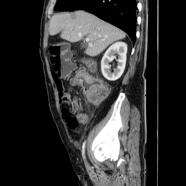 File:Adenocarcinoma of colon with entero-colic fistula (Radiopaedia 22832-22852 Sagittal C+ portal venous phase 19).jpg