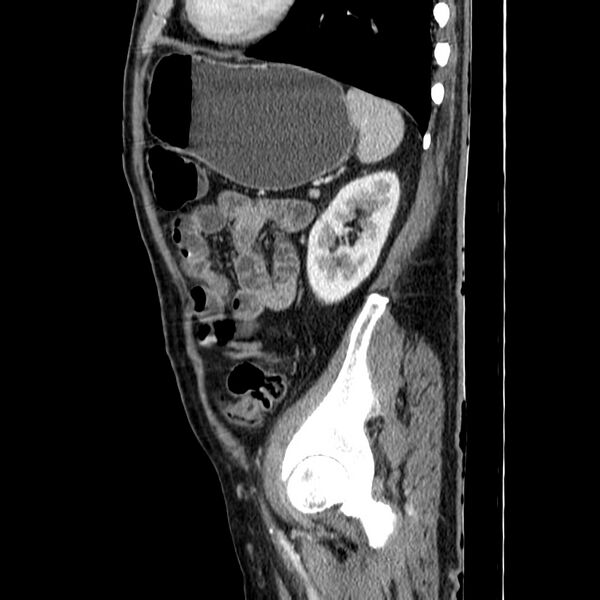 File:Adenocarcinoma of colon with entero-colic fistula (Radiopaedia 22832-22852 Sagittal C+ portal venous phase 49).jpg