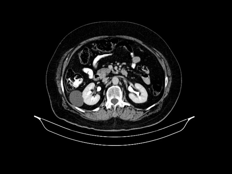 File:Adenocarcinoma of pancreas with hepatic metastasis (Radiopaedia 64332-73122 Axial C+ delayed 42).jpg