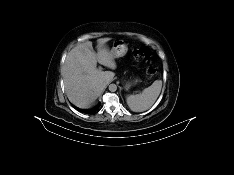 File:Adenocarcinoma of pancreas with hepatic metastasis (Radiopaedia 64332-73122 Axial non-contrast 25).jpg