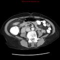 Adenocarcinoma of the colon (Radiopaedia 8191-9039 Axial liver window 43).jpg