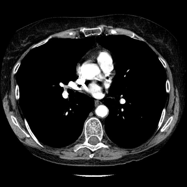 File:Adenocarcinoma of the lung (Radiopaedia 41015-43755 Axial C+ portal venous phase 63).jpg