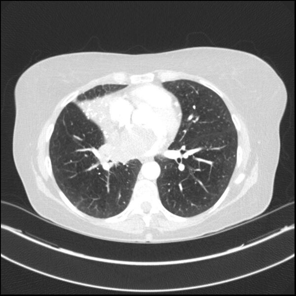 File:Adenocarcinoma of the lung (Radiopaedia 44205-47803 Axial lung window 55).jpg