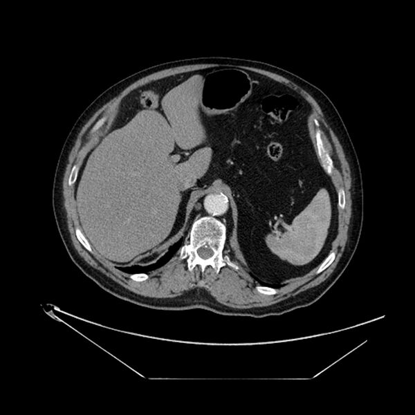 File:Adenocarcinoma of the lung (Radiopaedia 44876-48759 Axial C+ portal venous phase 81).jpg