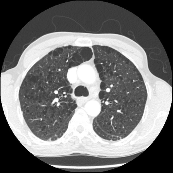 File:Adenocarcinoma of the lung - micropapillary predominant (Radiopaedia 42446-45563 C 4).jpg