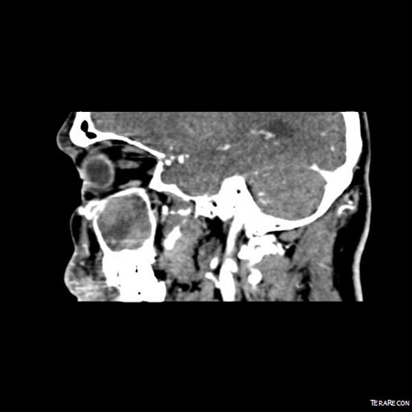 File:Adenoid cystic carcinoma involving paranasal sinus (Radiopaedia 16580-16283 Sagittal C+ arterial phase 10).jpeg