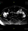 Adenomyosis (Radiopaedia 43504-46889 Axial DWI 1).jpg