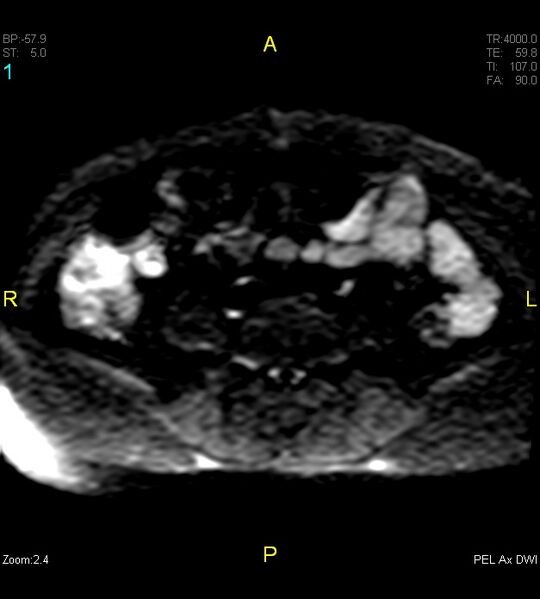 File:Adenomyosis (Radiopaedia 43504-46889 Axial DWI 1).jpg