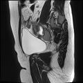 Adenomyosis - ovarian endometriomas (Radiopaedia 67031-76350 Sagittal T2 5).jpg