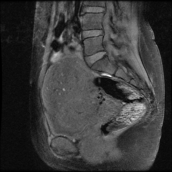 File:Adenomyosis on MRI (Radiopaedia 29328-29780 Sagittal T1 fat sat 7).jpg