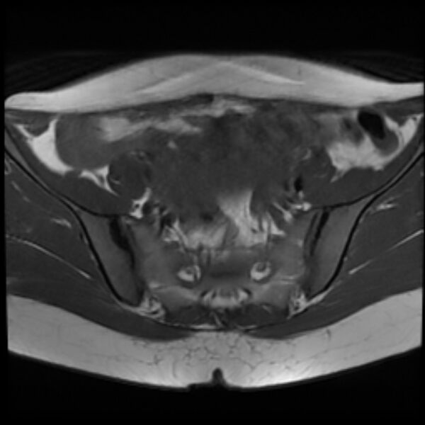 File:Adenomyosis within a septate uterus (Radiopaedia 69963-79981 Axial T1 10).jpg