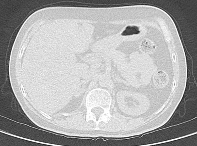 File:Adenosquamous lung carcinoma (Radiopaedia 22035-22030 lung window 62).jpg