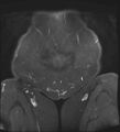 Adnexal multilocular cyst (O-RADS US 3- O-RADS MRI 3) (Radiopaedia 87426-103754 Coronal T2 fat sat 1).jpg
