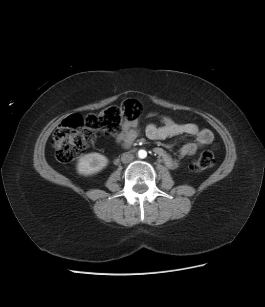 File:Adrenal cortical carcinoma with IVC invasion and thrombosis (Radiopaedia 34307-35597 Axial C+ arterial phase 48).jpg