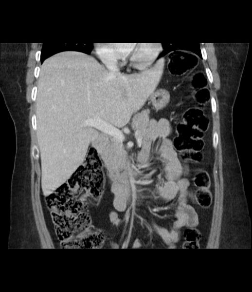 File:Adrenal cortical carcinoma with IVC invasion and thrombosis (Radiopaedia 34307-35597 Coronal C+ portal venous phase 24).jpg