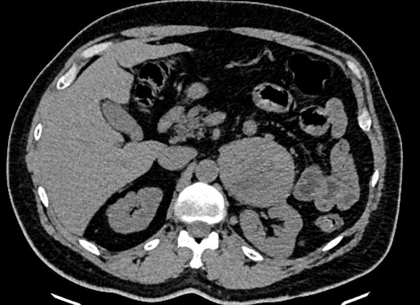 Adrenal metastases (Radiopaedia 73082-83791 Axial non-contrast 59).jpg
