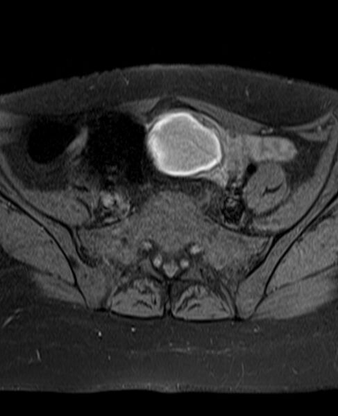File:Adult granulosa cell tumor of the ovary (Radiopaedia 71581-81950 Axial T1 fat sat 8).jpg