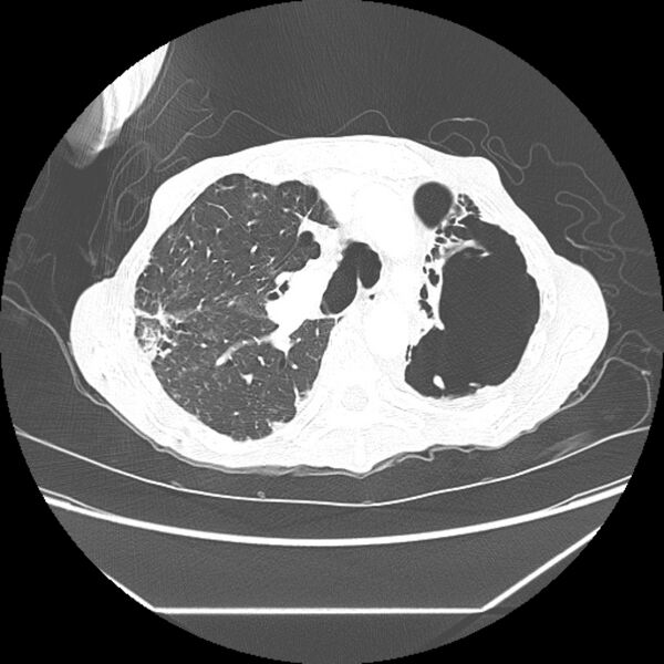 File:Advanced pulmonary tuberculosis (Radiopaedia 8599-9431 Axial lung window 17).jpg