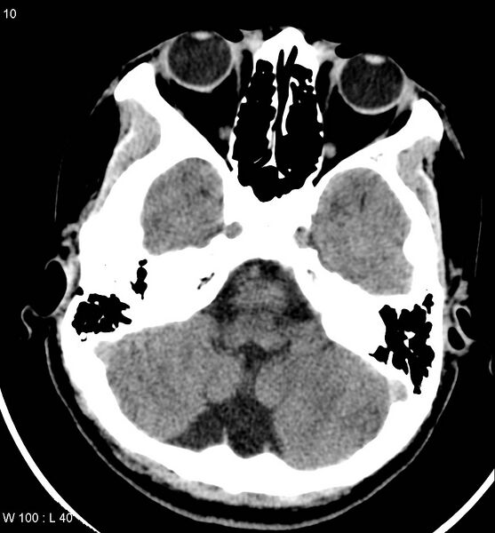 File:Aicardi syndrome (Radiopaedia 5353-7116 Axial non-contrast 7).jpg