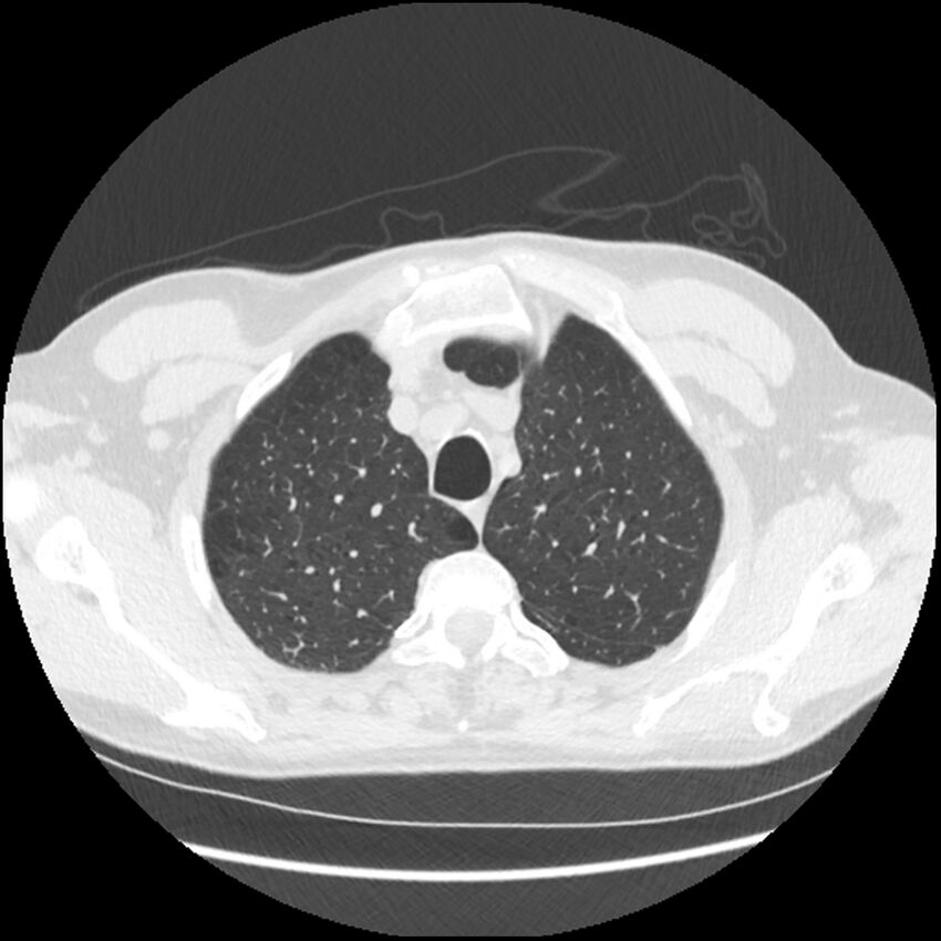 Alpha-1-antitrypsin deficiency (Radiopaedia 40993-43722 Axial lung window 34).jpg