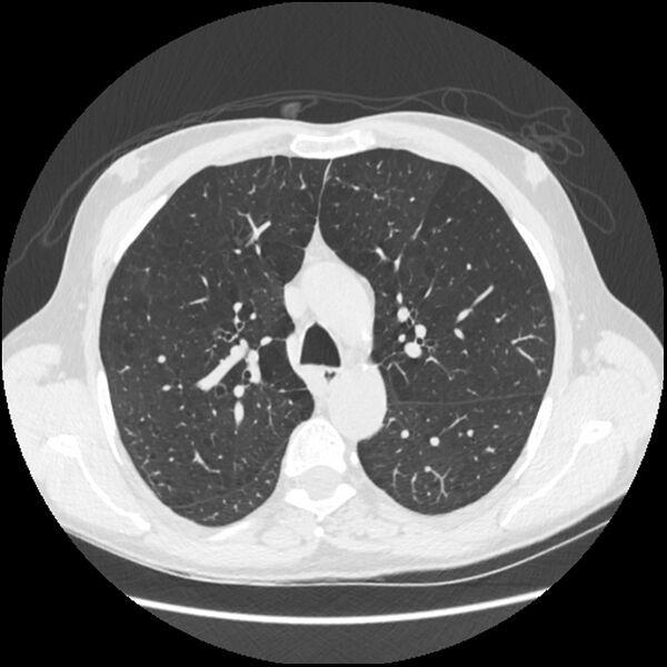 File:Alpha-1-antitrypsin deficiency (Radiopaedia 40993-43722 Axial lung window 79).jpg