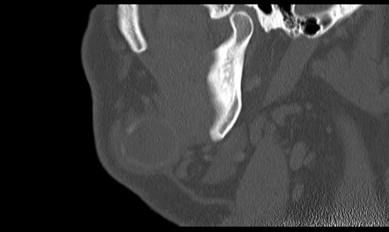 File:Ameloblastoma (Radiopaedia 33677-34806 Sagittal bone window 16).png