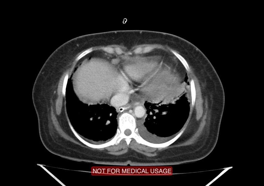 Amoebic enterocolitis with liver abscess (Radiopaedia 35100-36609 A 7).jpg