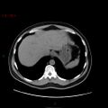 Ampullary carcinoma (Radiopaedia 56396-63056 Axial non-contrast 9).jpg