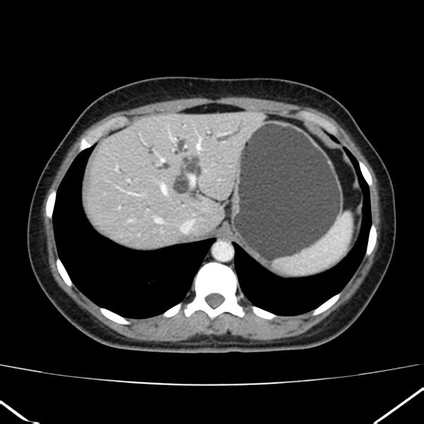 File:Ampullary tumor (Radiopaedia 22787-22816 C 12).jpg