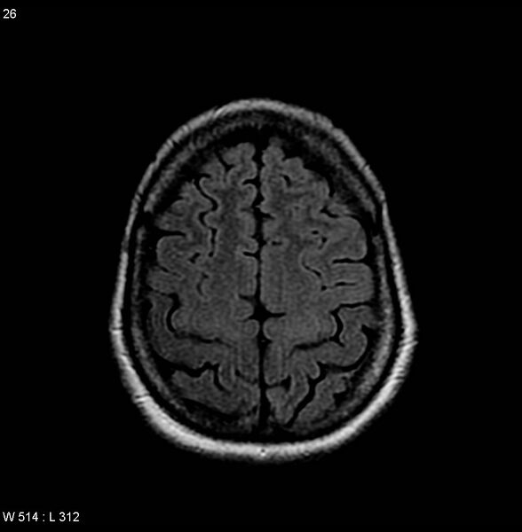 File:Amyotrophic lateral sclerosis (Radiopaedia 4719-6744 Axial FLAIR 8).jpg