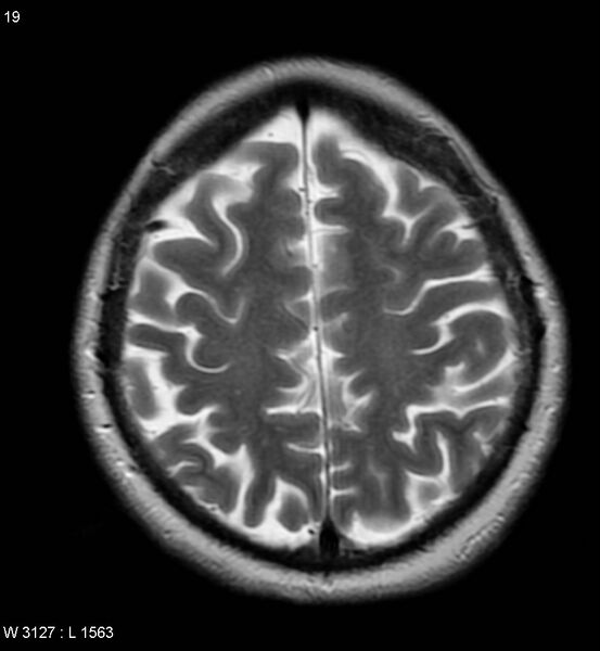 File:Amyotrophic lateral sclerosis (Radiopaedia 5373-7134 Axial T2 19).jpg