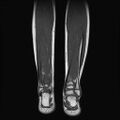 Aneurysmal bone cyst - tibia (Radiopaedia 22343-22367 Coronal T1 13).jpg