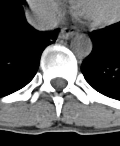File:Aneurysmal bone cyst T11 (Radiopaedia 29294-29721 Axial non-contrast 29).jpg