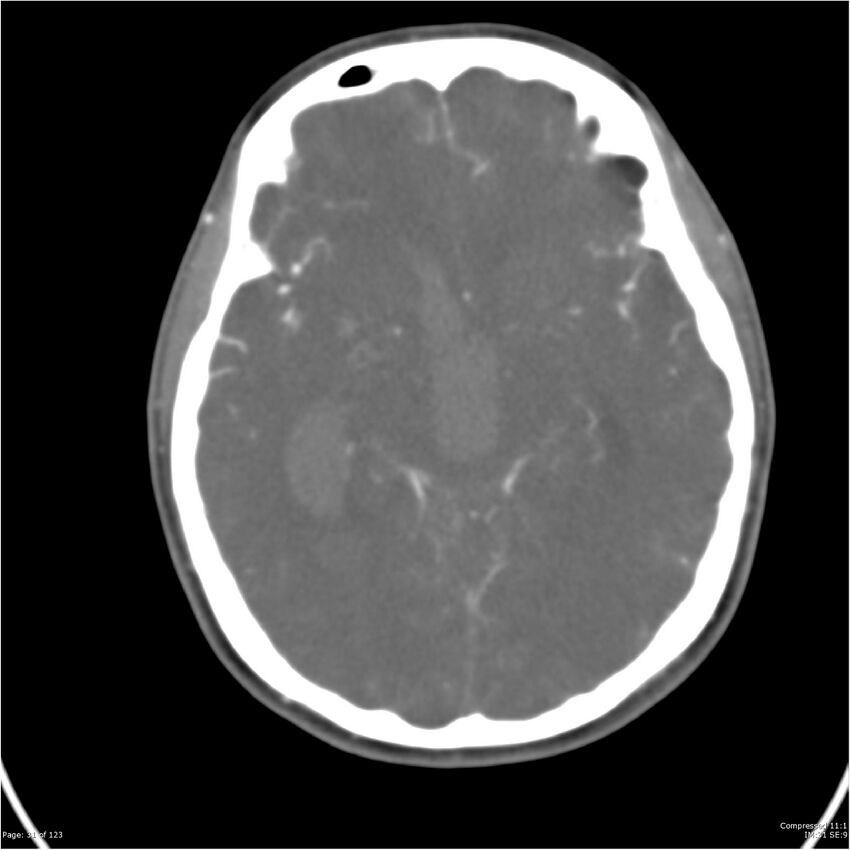 Aneurysmal subarachnoid hemorrhage and Moya Moya disease (Radiopaedia 34306-35593 Axial CT COW 31).jpg