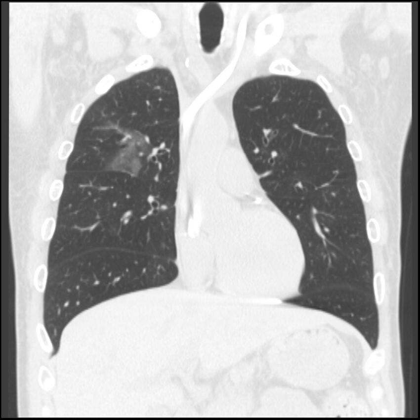 Angioinvasive aspergillosis (Radiopaedia 43957-47466 Coronal lung window 60).jpg