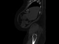 Ankylosing spondylitis (Radiopaedia 44609-48357 Sagittal bone window 3).jpg