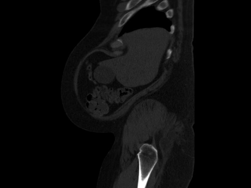 File:Ankylosing spondylitis (Radiopaedia 44609-48357 Sagittal bone window 3).jpg