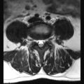 Ankylosing spondylitis with zygapophyseal arthritis (Radiopaedia 38433-40516 Axial T2 7).jpg