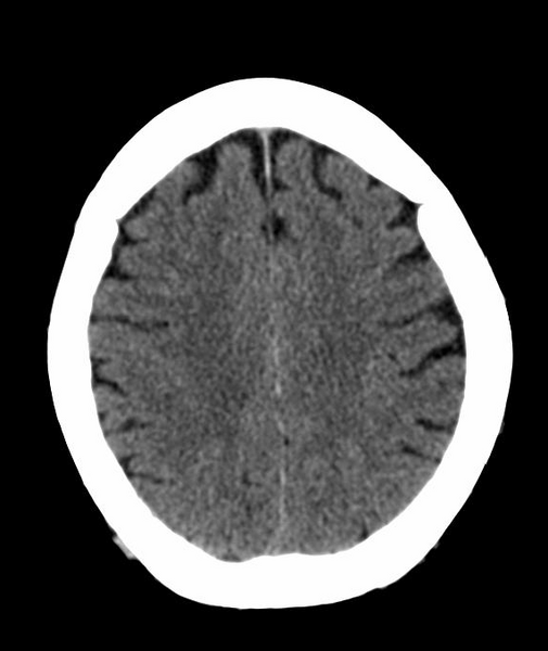 File:Anomalous intracranial venous drainage (Radiopaedia 28161-28418 Axial 38).png