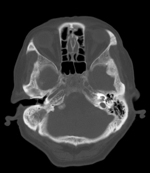 File:Anomalous intracranial venous drainage (Radiopaedia 28161-28418 Axial 7).png