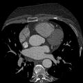 Anomalous origin of left circumflex artery from right coronary sinus (Radiopaedia 72563-83117 B 48).jpg