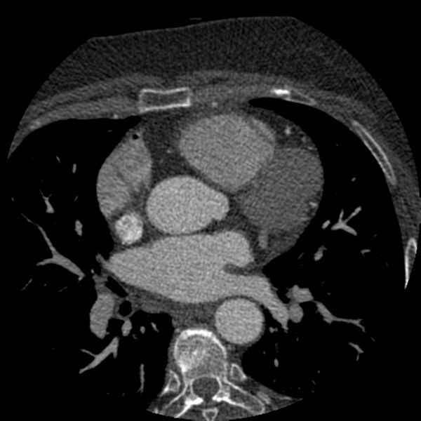 File:Anomalous origin of left circumflex artery from right coronary sinus (Radiopaedia 72563-83117 B 48).jpg