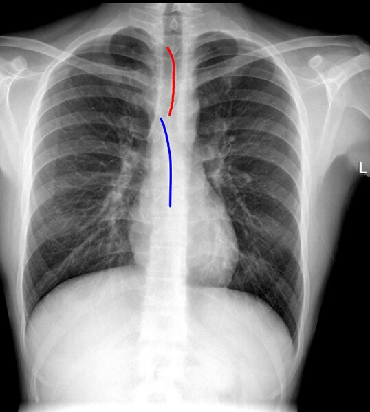 File:Anterior and posterior junctional lines (chest x-ray) (Radiopaedia 25419-25662 A 1).JPG
